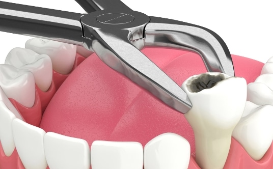 Teeth implants for wisdom teeth removal in Waterloo