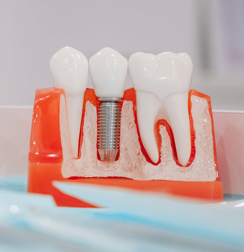 Dental implants Waterloo