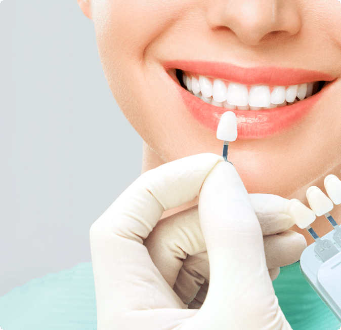 Woman smiling showing her Dental Veneers in Waterloo